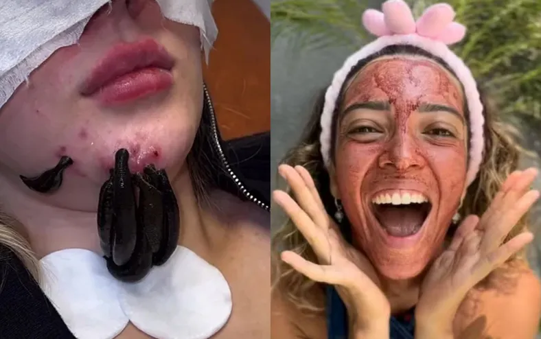 De sangue menstrual a vermes: saiba perigos dos procedimentos estéticos atuais - Imagem