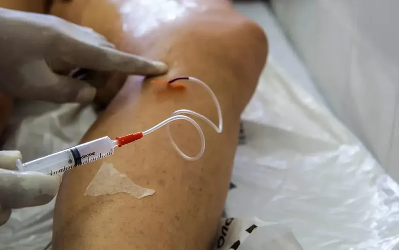 Mutirão gratuito realiza triagem para tratamento contra varizes - Imagem