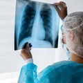 Câncer de pulmão pode ter até 95% de cura; conheça sinais de alerta imagem
