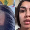 Mulher tem cabelo raspado em exame toxicológico para CNH imagem