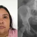 Raio-x de mulher presa por fingir ter 12 anos mostrou agulhas no corpo imagem