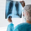 Estudo do Brasil revela impacto de gene em tumores do câncer de pulmão
