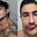 Influenciador é internado após espremer uma espinha na boca