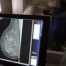 SUS terá teste genético para identificar risco hereditário de câncer de mama