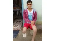Homem que amputou o próprio pé havia feito quatro seguros dias antes da fraude
