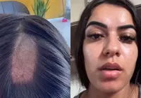Mulher tem cabelo raspado em exame toxicológico para CNH