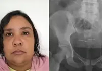 Raio-x de mulher presa por fingir ter 12 anos mostrou agulhas no corpo