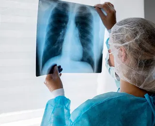 Câncer de pulmão pode ter até 95% de cura; conheça sinais de alerta