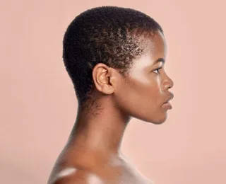 Dermatite seborreica pode provocar queda de cabelo em pessoas negras