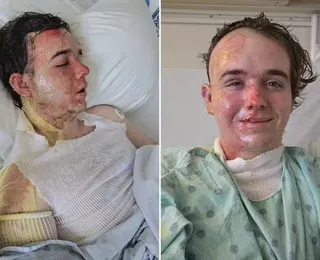 Funcionário do McDonald's é atacado com óleo fervente por colega