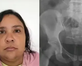 Raio-x de mulher presa por fingir ter 12 anos mostrou agulhas no corpo