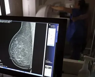 SUS terá teste genético para identificar risco hereditário de câncer de mama