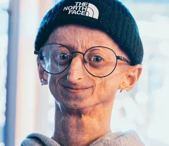 Aos 28 anos, morre influenciador com doença genética rara