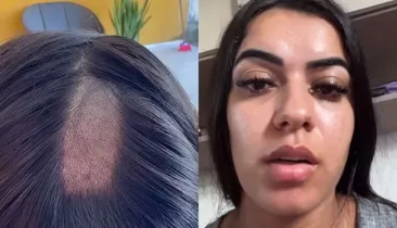 Mulher tem cabelo raspado em exame toxicológico para CNH