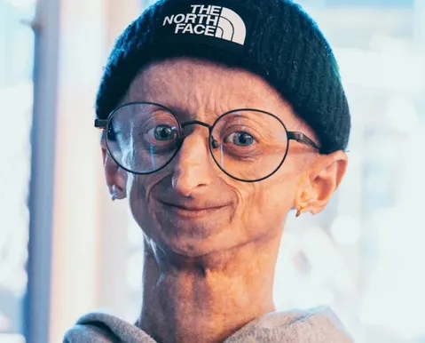 Aos 28 anos, morre influenciador com doença genética rara - Imagem