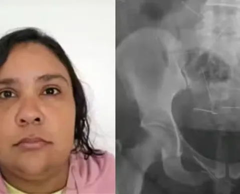 Raio-x de mulher presa por fingir ter 12 anos mostrou agulhas no corpo