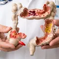 Aumento de câncer colorretal na população mais jovem acende alerta entre médicos imagem