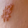 Herpes-zóster: vacina previne dor crônica e lesões na pele imagem