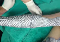 Curativo de Tilápia: entenda como pele de peixe está tratando feridas