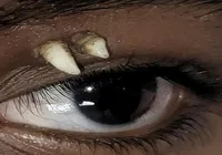 Jovem descobre dente raro crescendo acima do olho após fazer exame