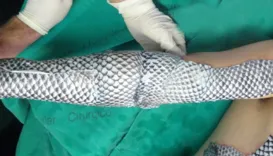 Curativo de Tilápia: entenda como pele de peixe está tratando feridas