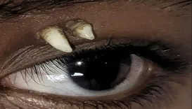 Jovem descobre dente raro crescendo acima do olho após fazer exame