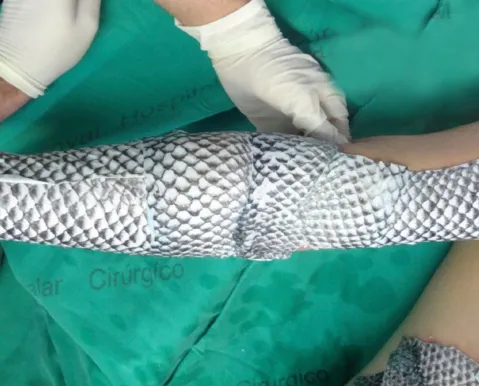 Curativo de Tilápia: entenda como pele de peixe está tratando feridas