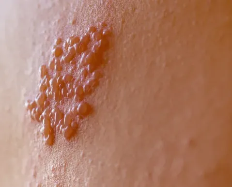 Herpes-zóster: vacina previne dor crônica e lesões na pele