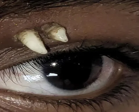 Jovem descobre dente raro crescendo acima do olho após fazer exame - Imagem