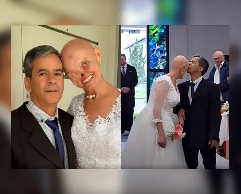 Mulher com 73 diagnósticos de câncer de pele se casa