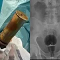 De bomba a lâmpada: veja casos de homens com objetos presos no ânus imagem