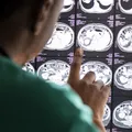 Meningite bacteriana: saiba o que fazer ao ter contato com a doença imagem