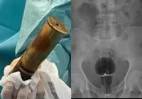 De bomba a lâmpada: veja casos de homens com objetos presos no ânus imagem