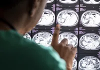 Meningite bacteriana: saiba o que fazer ao ter contato com a doença imagem
