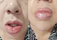 Mais de 1,2 mil pessoas têm reação à pasta da Colgate, diz Anvisa