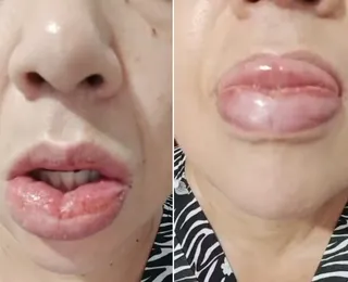 Mais de 1,2 mil pessoas têm reação à pasta da Colgate, diz Anvisa