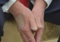 Entenda motivo pelo qual Donald Trump usa maquiagem na mão