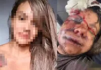 Vítima de ataque brutal no elevador vai precisar de reconstrução facial imagem