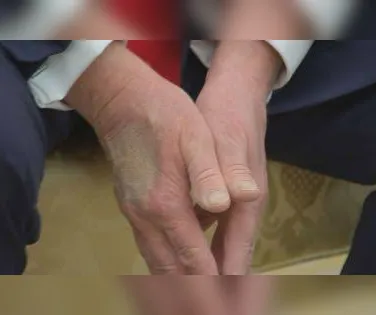 Entenda motivo pelo qual Donald Trump usa maquiagem na mão - Imagem