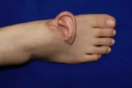 Inédito! Médicos costuram orelha no pé para manter mulher viva - Imagem