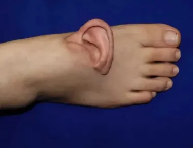 Inédito! Médicos costuram orelha no pé para manter mulher viva - Imagem