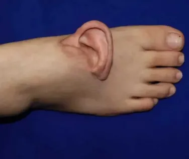 Inédito! Médicos costuram orelha no pé para manter mulher viva - Imagem