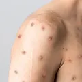 Bahia tem dois casos confirmados de Mpox; um deles em Salvador imagem