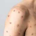 Bahia monitora novo caso suspeito de Mpox em Irecê imagem