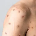 Brasil registra 55 casos de Mpox em 2026 e mantém vigilância reforçada imagem