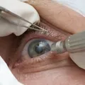 Chega a 13 número de pacientes sem visão após cirurgia de catarata em Salvador imagem