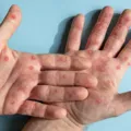 Secretaria de Saúde da Bahia atualiza casos de Mpox no estado em 2026 imagem