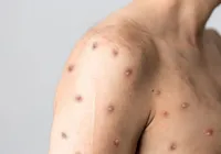 Bahia tem dois casos confirmados de Mpox; um deles em Salvador imagem
