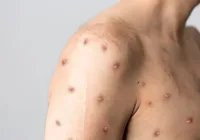 Bahia monitora novo caso suspeito de Mpox em Irecê imagem
