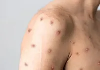 Brasil registra 55 casos de Mpox em 2026 e mantém vigilância reforçada imagem